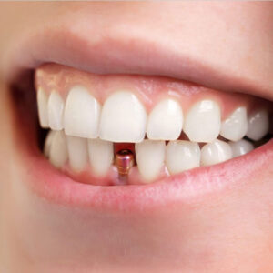 Unraveling the Teeth Breaking Dream Meaning: What It Reveals