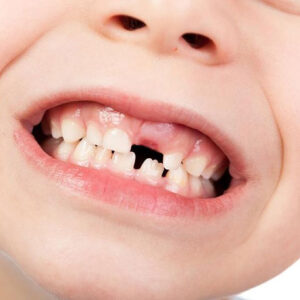 Reveal the Message: Upper Teeth Falling Out Dream Unveiled